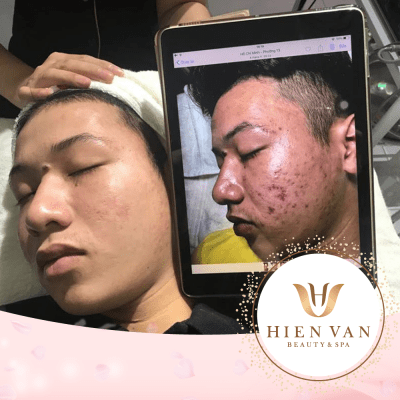 Trị mụn bao lâu mới nhìn thấy được kết quả