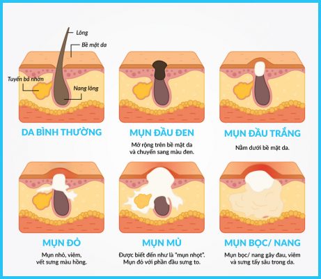 Trị mụn bao lâu mới nhìn thấy được kết quả