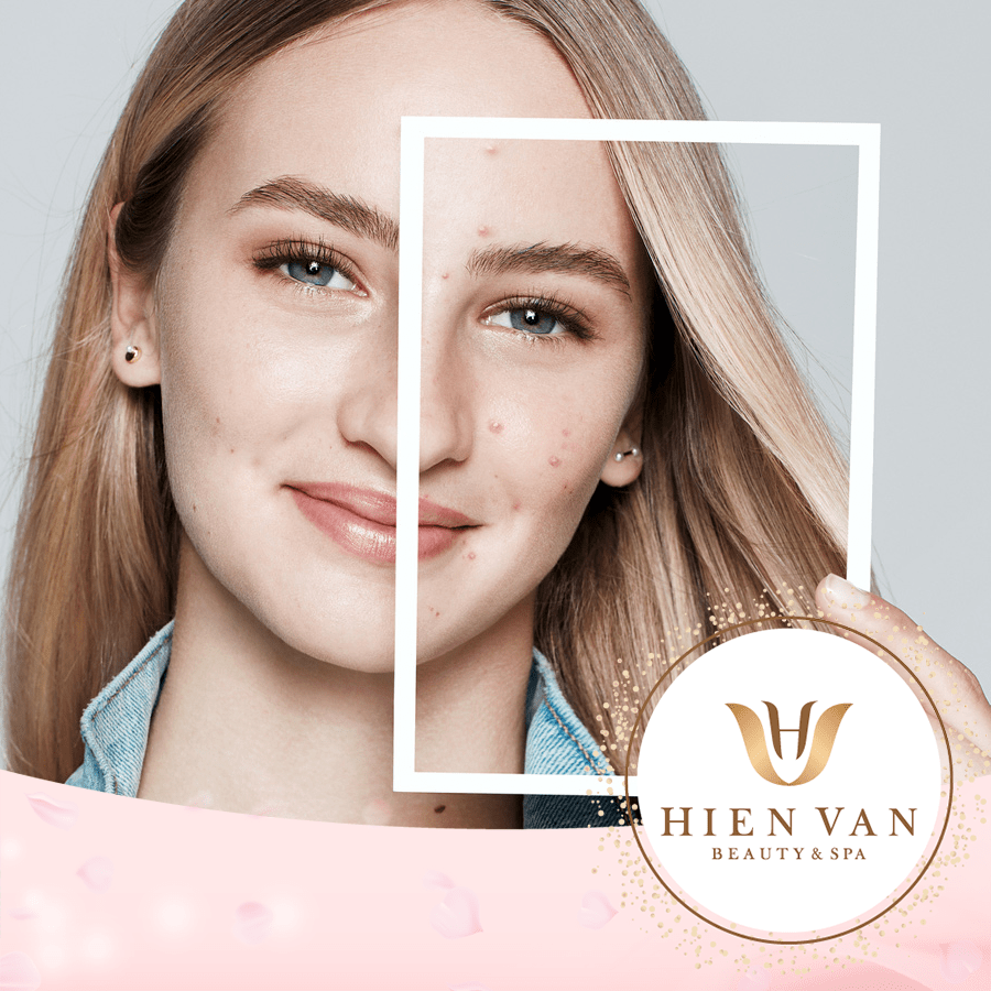 Trị mụn công nghệ ánh sáng sinh học tại Phòng Khám Da Liễu HHV Clinic