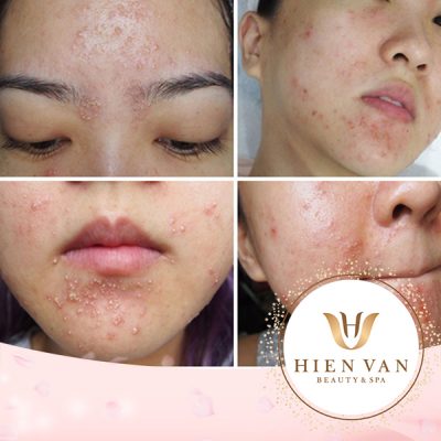 khi tuyến bã nhờn hoạt động quá mức tạo ra bã nhờn dư thừa thì làn da của bạn sẽ bóng dầu và lỗ chân lông của bạn có thể bị tắc nghẽn