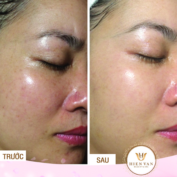 Điện di collagen tại Phòng Khám Da Liễu HHV Clinic