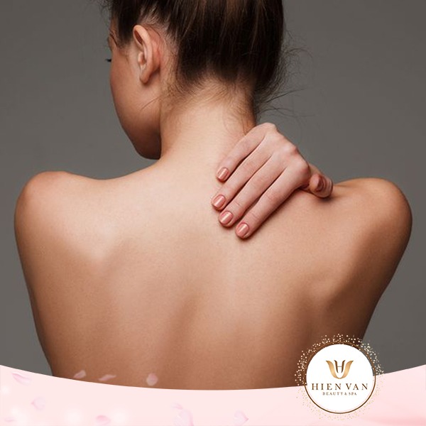 Mụn lưng do yếu tố di truyền