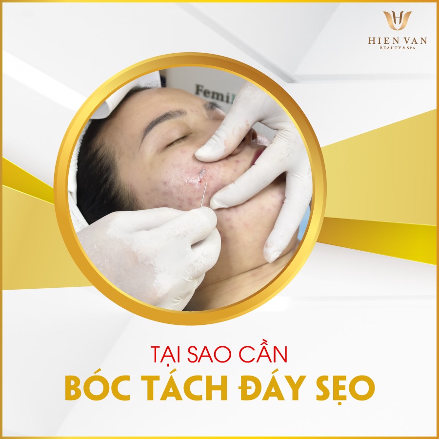 bóc tách đáy sẹo rỗ