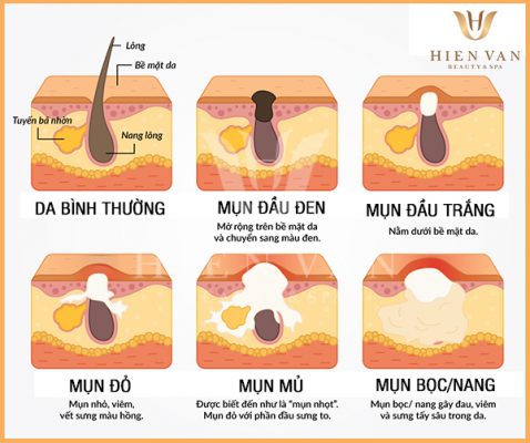 Các loại mụn thường gặp