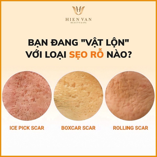 Điều trị sẹo rỗ tại Phòng Khám Da Liễu HHV Clinic
