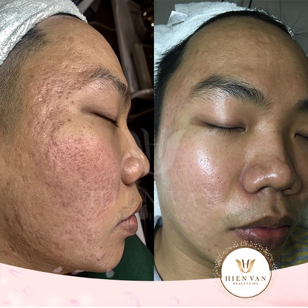 Điều trị sẹo rỗ tại Phòng Khám Da Liễu HHV Clinic