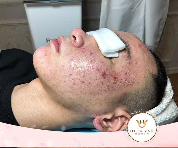 Điều trị sẹo rỗ bằng Pixel CO2