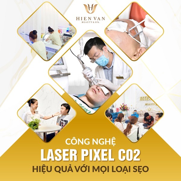 Điều trị sẹo bằng laser Pixel vi điểm