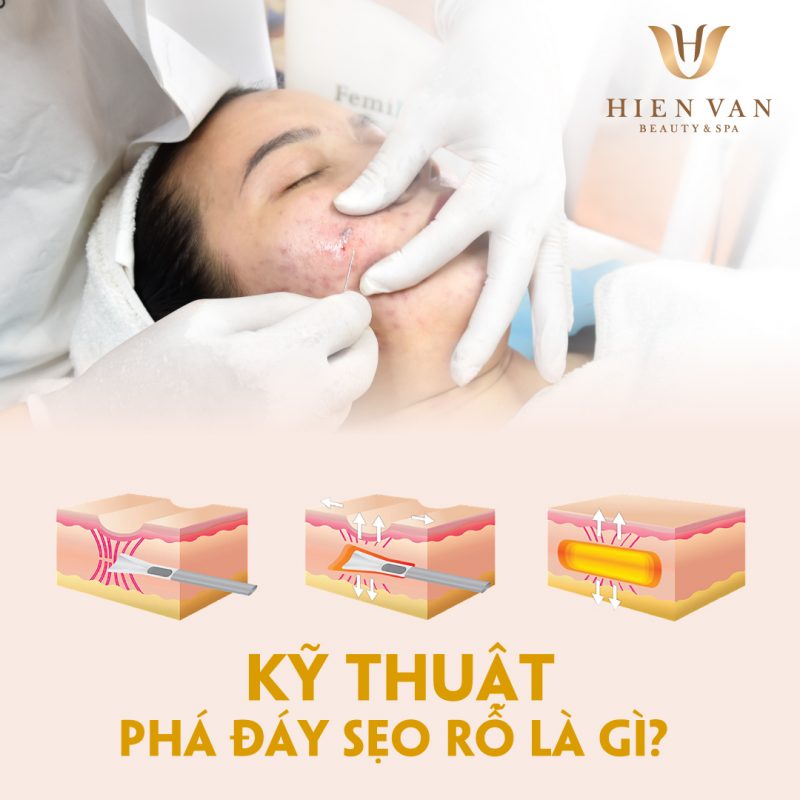 Bóc tách đáy sẹo rỗ
