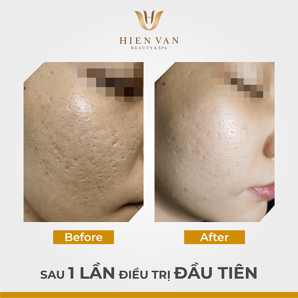 Điều trị sẹo rỗ bao nhiêu buổi hiệu quả