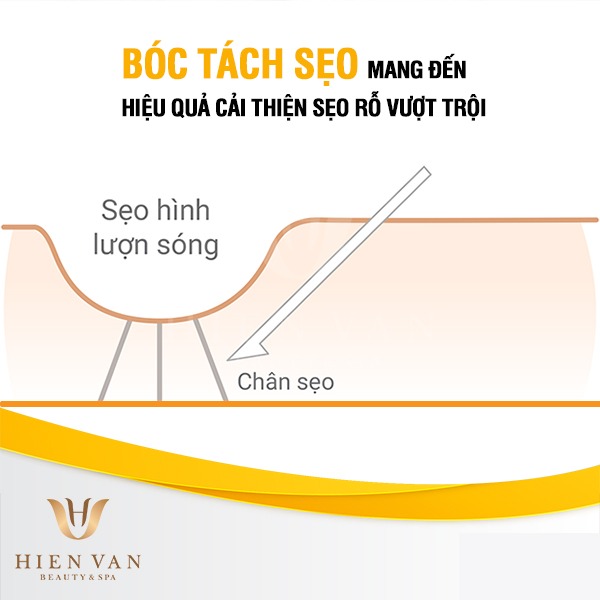 Bóc tách đáy sẹo