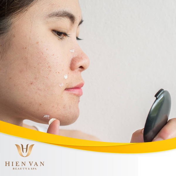 Kem đánh răng trị mụn