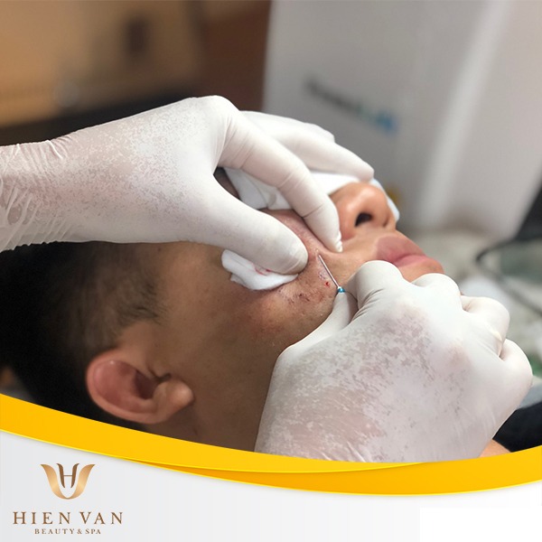 Tại sao hiệu quả trị sẹo ở mỗi người khác nhau