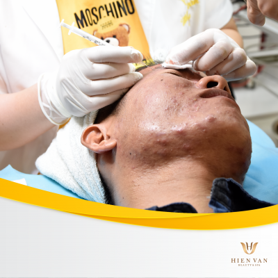 Lấy nhân mụn không thâm sẹo tại HHV Clinic