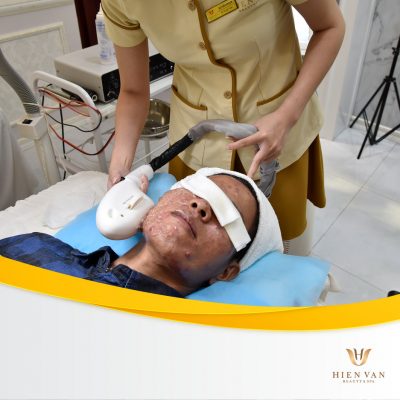 Trị mụn cằm phác đồ chuẩn chuyên gia.