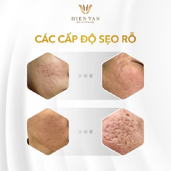 Các cấp độ khác nhau của sẹo rỗ