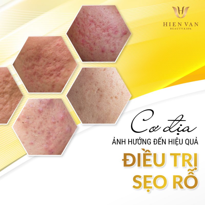 Cơ địa ảnh hưởng đến hiệu quả trị sẹo rỗ