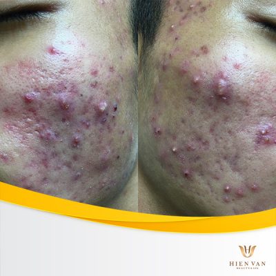 Da bị mụn có thể điều trị sẹo được không