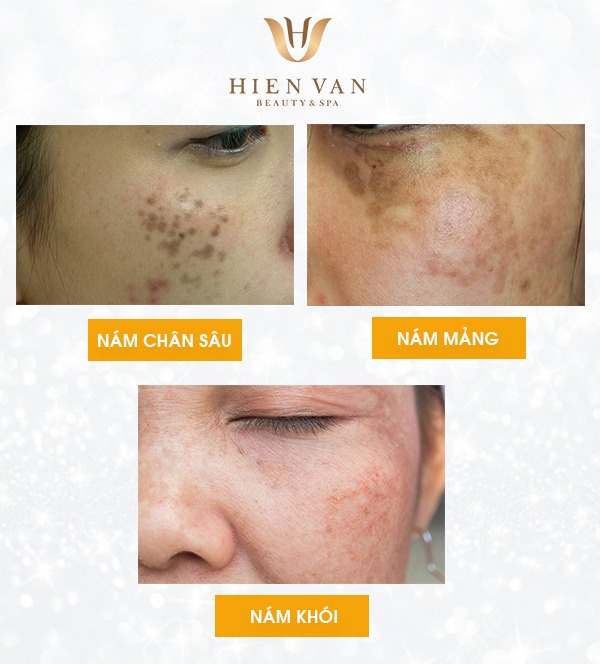 Các loại nám thường gặp