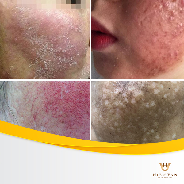 Biến chứng sau khi ngưng sử dụng kem trộn