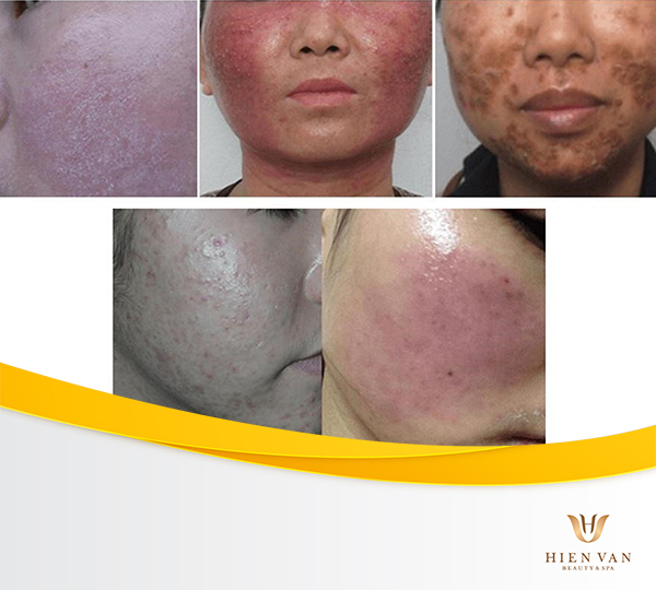 Tăng sắc tố do dùng kem trộn