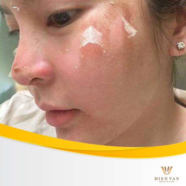 Peel da điều trị thâm