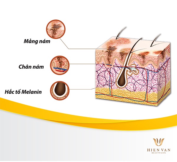 Cơ chế hình thành nám, tàn nhang, đốm nâu