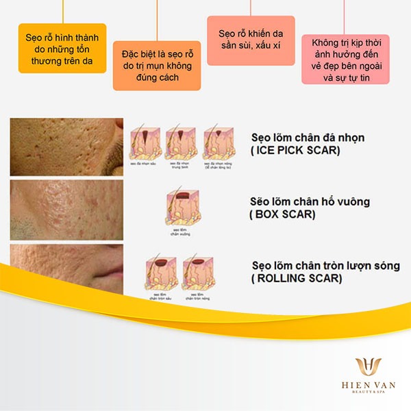 Nguyên nhân hình thành sẹo rỗ