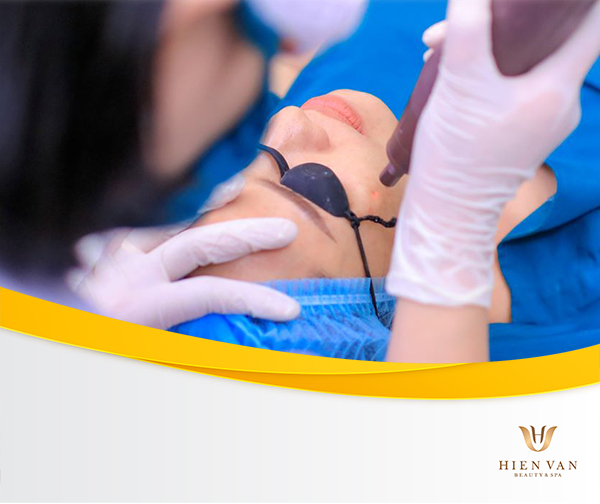 Điều trị nám bằng laser