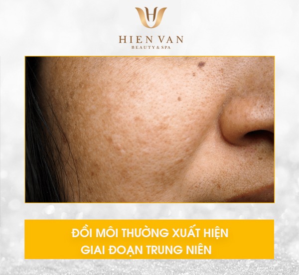 Hình thái đồi mồi xuất hiện trên da