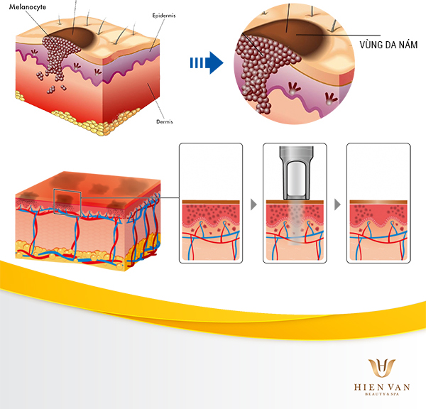 Cơ chế hoạt động của laser trị nám