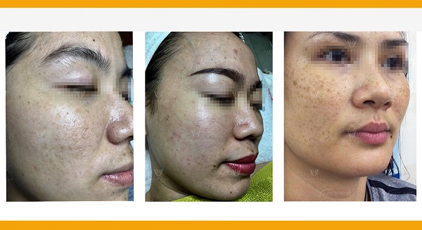 Mật độ tàn nhang quyết định hiệu quả điều trị
