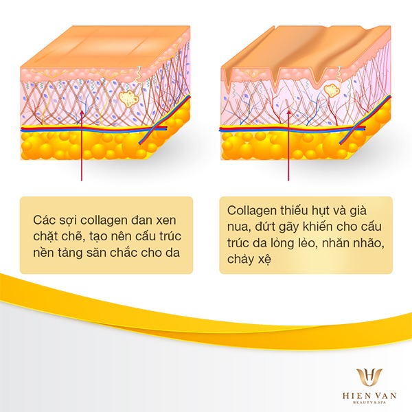 Nám da do sự sụt giảm collagen