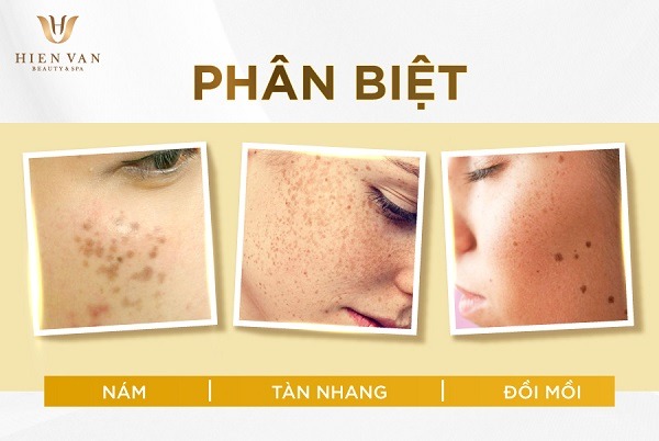 Phân biệt nám, tàn nhang, đốm nâu