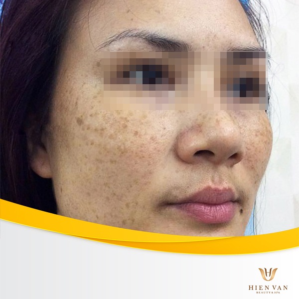 Tàn nhang thường bị nhầm lẫn với nám chân sâu