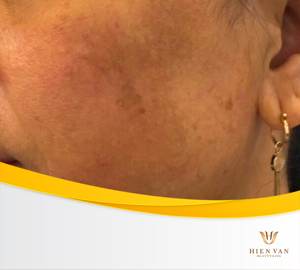 Tăng sắc tố do điều trị laser sai cách