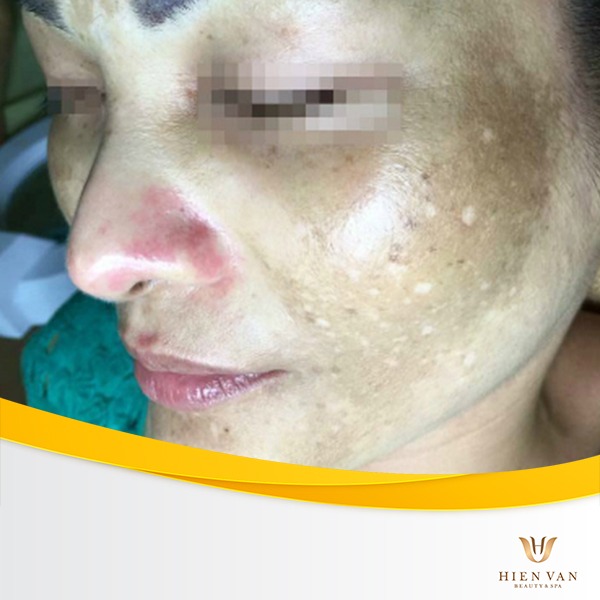 Trị nám da bằng kem trộn