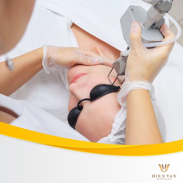 Điều trị tàn nhang bằng laser 