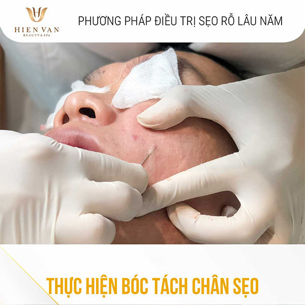 Bóc tách chân sẹo là phuuwong pháp trị sẹo rỗ chân vuông giúp ngăn tái lõm hiệu quả
