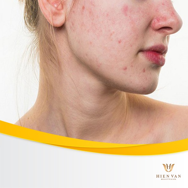 Giai đoạn 1: Da bị viêm