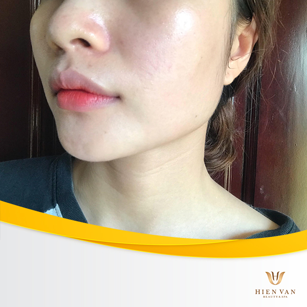Những ngày đầu mới sử dụng kem trộn da rất đẹp