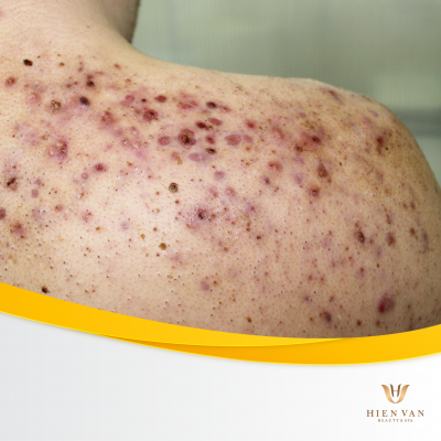 Điều trị viêm nang lông tại nhà