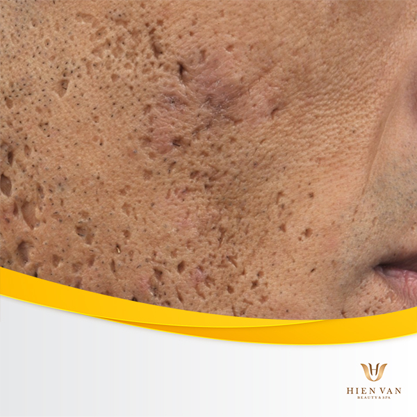 Hậu quả khi tự điều trị sẹo sai cách