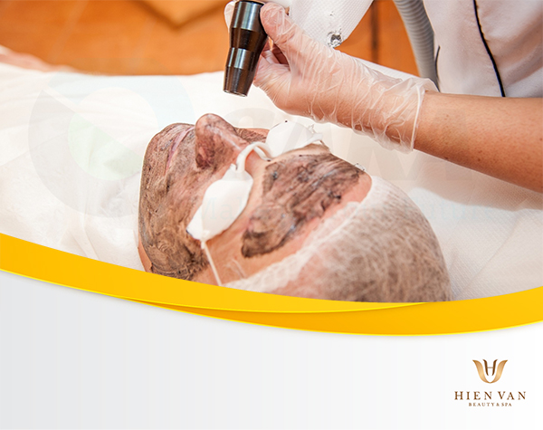 Lựa chọn loại laser phù hợp để điều trị tàn nhang