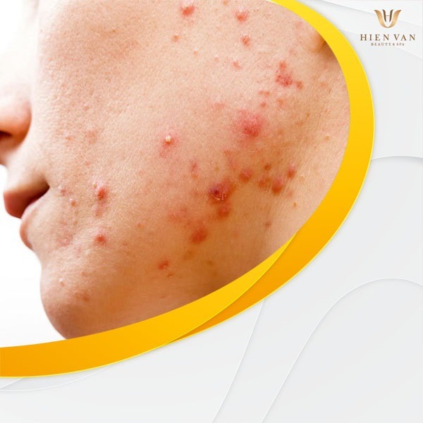 Nên lấy nhân mụn tại nhà hay nhất định phải đến Spa?
