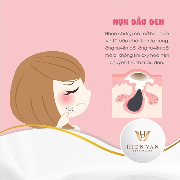 10 cách loại bỏ mụn đầu đen siêu đơn giản mà hiệu quả nhất