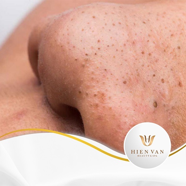 10 cách loại bỏ mụn đầu đen siêu đơn giản mà hiệu quả nhất