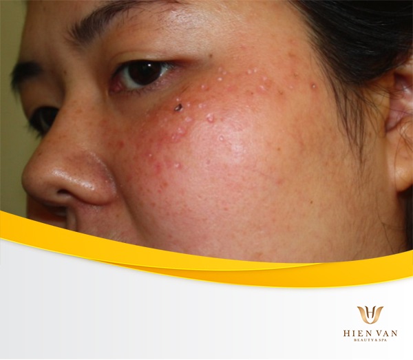 Bị sẹo rỗ do điều trị laser kém chất lượng