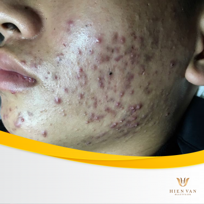 Điều trị mụn dậy thì hiệu quả