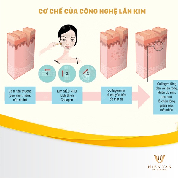 Điều trị sẹo rỗ bằng lăn kim